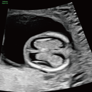 胎児ドックの様子_初期