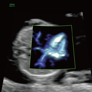 胎児ドックの様子_初期