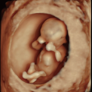 胎児ドックの様子_初期