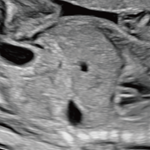 胎児ドックの様子_中期_腹部