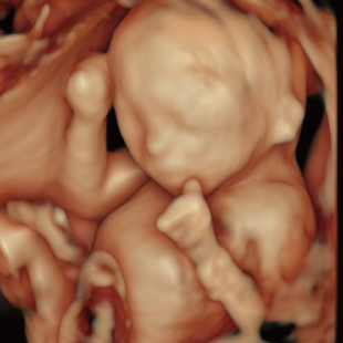 胎児ドックの様子_中期_4D